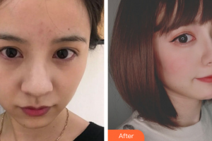 廣州軍美整形醫(yī)院張衛(wèi)華整形價(jià)格表附光子嫩膚全臉案例展示