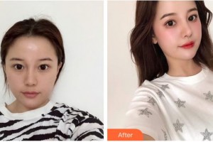 成都愛迪眼科醫(yī)院譚永福整形價格表附眼部手術(shù)案例展示