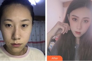 成都愛迪眼科醫(yī)院楊雨昆整形價格表附眼部手術(shù)案例展示