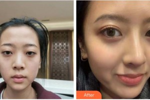 成都市新都區(qū)人民醫(yī)院眼科李文華整形價格表附雙眼皮案例展示