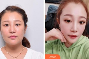 成都佰視達(dá)眼科門診部趙小虎整形價格表附眼部綜合案例展示