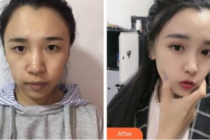 成都世紀(jì)眼科醫(yī)院張潔整形價格表附眼部綜合案例展示