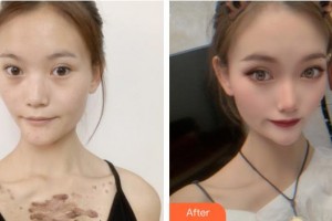 成都市新都區(qū)人民醫(yī)院眼科蔣娛整形價格表附雙眼皮內(nèi)眼角案例展示