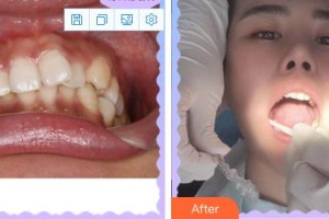 成都佰視達(dá)眼科門診部林文整形價格表附牙綜合案例展示