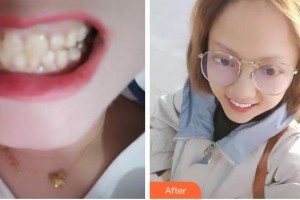 成都華西牙種植醫(yī)院吳大怡整形價格表附牙齒陶瓷貼面案例展示