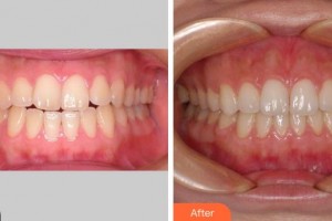 成都君臣口腔門診部霖整形價格表附牙齒正畸案例展示