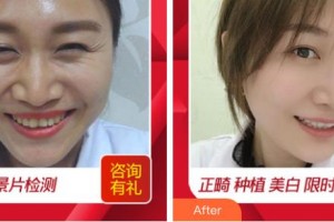 成都德道口腔醫(yī)院羅君整形價格表附美白牙齒案例展示