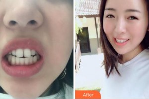 成都潔西口腔診所王周斌整形價格表附隱形矯正案例展示