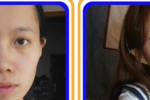 成都愛視眼科醫(yī)院李新立整形價格表附眼部手術案例展示