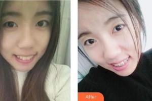 成都君臣口腔門診部王君臣整形價格表附金屬托槽矯正案例展示