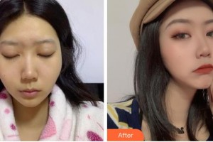 成都天姿醫(yī)療美容門診部李雯雯整形價格表附顴骨內推案例展示