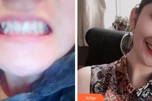 成都華陽微笑口腔診所王冰蓉整形價格表附牙齒矯正案例展示