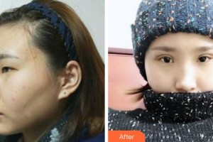 成都愛視眼科醫(yī)院李偉力整形價格表附眼部手術案例展示