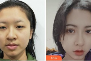 成都天姿醫(yī)療美容門診部譚超整形價格表附切開雙眼皮案例展示