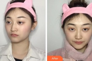 成都中醫(yī)大銀海眼科醫(yī)院鄧亞平整形價格表附眼部整形案例展示