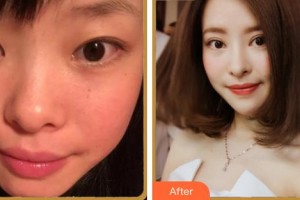 成都中醫(yī)大銀海眼科醫(yī)院段俊國整形價格表附眼部多項案例展示