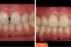 成都龍普蘭特口腔門診部王曉霞整形價格表附牙綜合案例展示