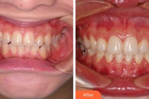 成都青木牙科診所李團團整形價格表附牙齒矯正案例展示