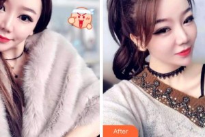 成都潔西口腔診所黃維慶整形價格表附牙齒矯正案例展示