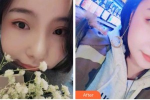 成都潔西口腔診所董凱整形價格表附牙齒矯正案例展示