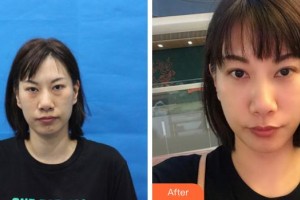 成都中醫(yī)大銀海眼科醫(yī)院張富文整形價格表附去眼袋案例展示