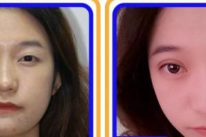 成都中醫(yī)大銀海眼科醫(yī)院路雪婧整形價格表附眼部整形案例展示