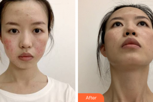 廣州康華清醫(yī)學(xué)美容門診部王群整形價(jià)格表附點(diǎn)陣激光祛痘案例展示