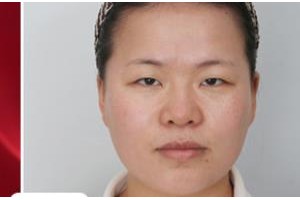 成都中醫(yī)大銀海眼科醫(yī)院周春陽整形價格表附切開雙眼皮案例展示