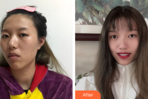 廣州從化現(xiàn)代醫(yī)院歐陽志珊整形價(jià)格表附白瓷娃娃案例展示