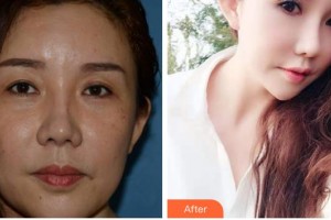 成都中醫(yī)大銀海眼科醫(yī)院張大錚整形價格表附眼部綜合案例展示