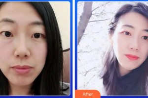 成都中醫(yī)大銀海眼科醫(yī)院廖品正整形價(jià)格表附雙眼皮案例展示