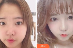 成都中醫(yī)大銀海眼科醫(yī)院潘學(xué)會(huì)整形價(jià)格表附眼部整形案例展示