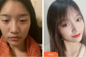 成都中醫(yī)大銀海眼科醫(yī)院李蓓整形價(jià)格表附眼部整形案例展示