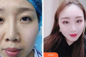 成都中醫(yī)大銀海眼科醫(yī)院尹朔住院醫(yī)師整形價(jià)格表附眼部修復(fù)案例展示