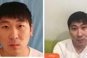 成都中醫(yī)大銀海眼科醫(yī)院王利萍住院醫(yī)師整形價(jià)格表附切開(kāi)雙眼皮案例展示