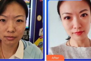 成都新視界眼科醫(yī)院余小清整形價(jià)格表附5s重瞼術(shù)+超微創(chuàng)開(kāi)內(nèi)眥案例展示