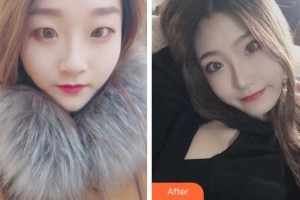 成都新視界眼科醫(yī)院許海嘉整形價(jià)格表附眼部整形案例展示