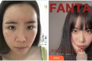 成都新視界眼科醫(yī)院屈雪梅整形價(jià)格表附切開(kāi)重瞼+內(nèi)眥贅皮矯正案例展示