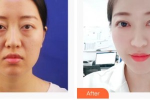 成都新視界眼科醫(yī)院李靜整形價(jià)格表附眼部綜合案例展示