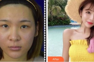 成都新視界眼科醫(yī)院蔡立歡整形價(jià)格表附眼部綜合案例展示