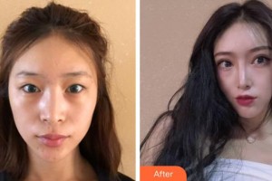 成都美壹典醫(yī)療美容診所魏鵬整形價(jià)格表附切開雙眼皮案例展示