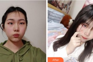 成都美壹典醫(yī)療美容診所楊皓月整形價(jià)格表附超激光美膚案例展示