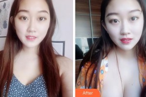 福建省立醫(yī)院整形外科劉加寧整形價(jià)格表附豐胸案例展示