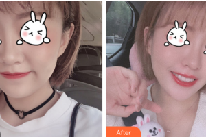 廣州韓妃醫(yī)學(xué)美容醫(yī)院黃倫武整形價(jià)格表附光子嫩膚案例展示