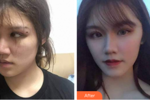 廣州中科美整形醫(yī)院鄧詠整形價(jià)格表附人魚膠提升術(shù)案例展示