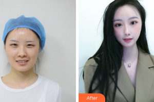 廣州天姿醫(yī)學(xué)美容門診部侯文明整形價(jià)格表附眼部整形案例展示