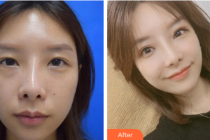 廣州尚美善造美容醫(yī)院葉蓓慧整形價(jià)格表附雙眼皮修復(fù)案例展示