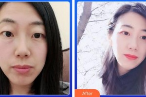 福建武警總隊(duì)醫(yī)院激光美容中心都志杰整形價(jià)格表附5s雙眼皮案例展示