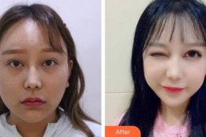 福建省立醫(yī)院整形外科鄭勝武整形價(jià)格表附雙眼皮+眼瞼下至案例展示