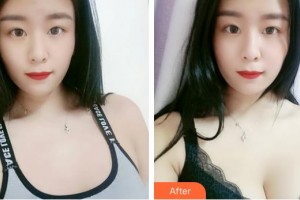 福建武警總隊(duì)醫(yī)院激光美容中心吳云飛整形價(jià)格表附濃縮豐胸真實(shí)案例展示
